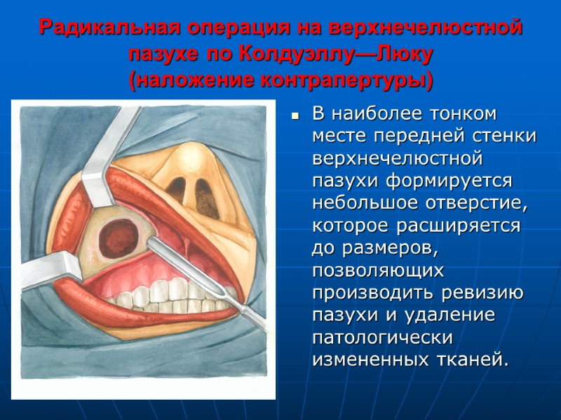 Радикальная операция на верхнечелюстной пазухе по Колдуэллу—Люку  (наложение контрапертуры) В наиболее тонком месте